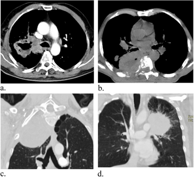Внесок комп'ютерної томографії в онкологію Внесок комп'ютерної томографії в онкологію