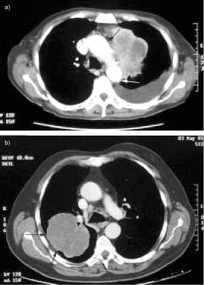 Внесок комп'ютерної томографії в онкологію Внесок комп'ютерної томографії в онкологію