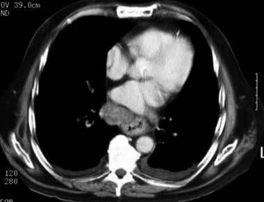 Як КТ допомагає виявити захворювання стравоходу? Як КТ допомагає виявити захворювання стравоходу?