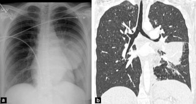 Як КТ допомагає виявити захворювання легень? Як КТ допомагає виявити захворювання легень?