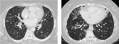 Яку роль відіграє КТ в оцінці ефективності лікування захворювань? Яку роль відіграє КТ в оцінці ефективності лікування захворювань?